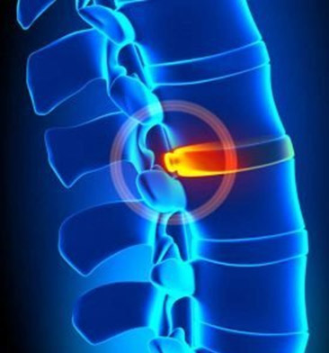 Chronic Back Pain