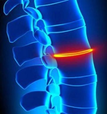 Facet Syndrome Degenerative Disc Diseas